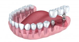 Implants dentaires en Hongrie