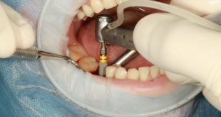 Ce qu'il faut savoir sur les complications et les échecs des implants dentaires